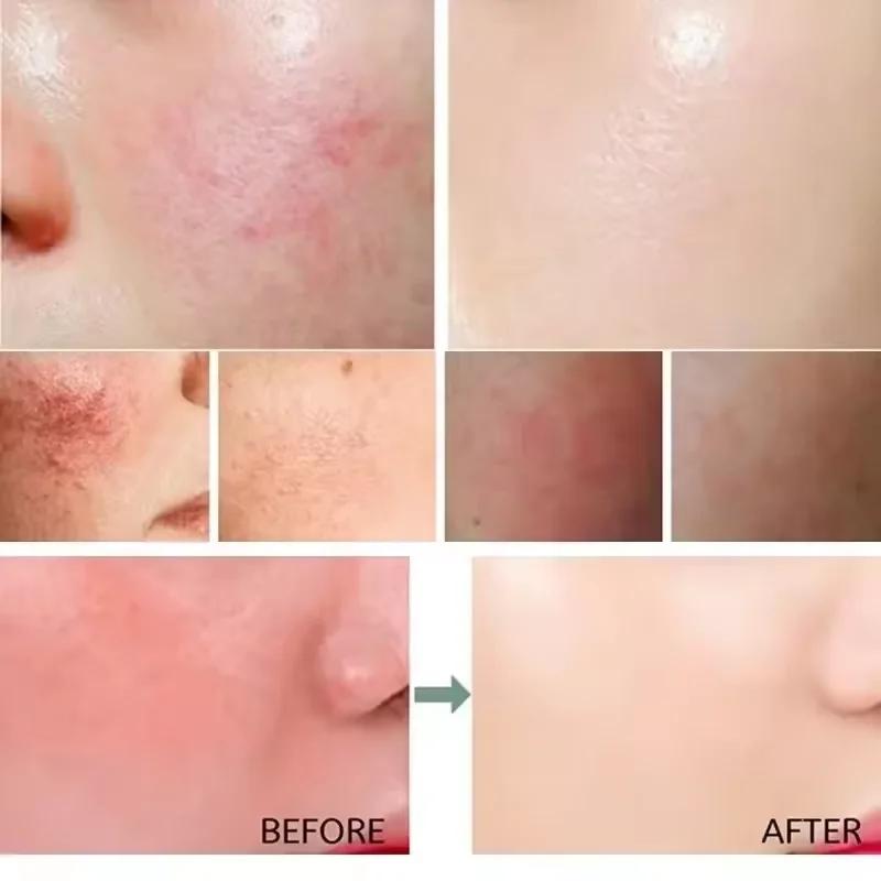 Facial Redness Repair Cream Im - Coenzyme Q10 Cream 评论和价格